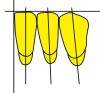 Figure 25  Schematics (25.) Mesio-distal inclinations of the mandibular anterior teeth and incisal position after adjustment to maintain 