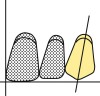 Figure 27  Schematics (27.) Altered maxillary canine position, up to 1 mm coronal to the incisal plane.