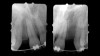Figure 1  PRE-TREATMENT DIAGNOSTICS Pretreatment radiographs revealed convergent roots for the right canine and right central.