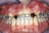 Figure 4  DIAGNOSTIC INFORMATION Significant crestal width of keratinized tissue, buccal view.