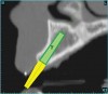 Figure 6  SOFTWARE IMAGING CT scan data was input into the treatment-planning software, which allowed placement of a simulated implant.