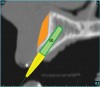 Figure 9  SOFTWARE IMAGING This allowed a simulated bone graft to be placed.