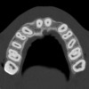 Figure 10  SOFTWARE IMAGING By slicing the maxilla axially, the images revealed the differing morphology of the central incisors, canines, premolar, and molar roots.