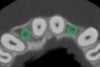 Figure 11  SOFTWARE IMAGING  The left simulated implant can be seen encroaching on the adjacent lamina dura.