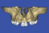 Figure 12  SOFTWARE IMAGING The 3D reconstruction showed the facial concavities and root eminences.