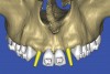 Figure 13  SOFTWARE IMAGING This allowed for evaluation of virtual implant placement to ensure the facial cortical plate was not perforated.
