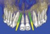 Figure 16  SOFTWARE IMAGING Virtual implants were placed to determine the appropriate shape and type for the available space, in this case a tapered design allowed for adequate mesial-distal distance between adjacent roots.