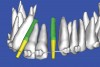 Figure 17   SOFTWARE IMAGING Virtual implants were placed to determine the appropriate shape and type for the available space, in this case a tapered design allowed for adequate mesial-distal distance between adjacent roots.