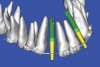 Figure 18   SOFTWARE IMAGING Virtual implants were placed to determine the appropriate shape and type for the available space, in this case a tapered design allowed for adequate mesial-distal distance between adjacent roots.