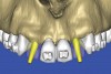 Figure 20  SOFTWARE IMAGING The abutment projection was evaluated for a cementable prosthesis.