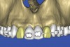 Figure 21  SOFTWARE IMAGING The appearance of the desired virtual restorations was evaluated for emergence and esthetics.