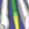 Figure 22  VIRTUAL PLANNING AND SURGERY  By zooming in on the digital image, the implant-to-tooth distances can be assessed at the crest.