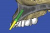 Figure 24  VIRTUAL PLANNING AND SURGERY By sectioning the 3D model, virtual implant placement was assessed for the necessary 2 mm of facial and palatal bone surrounding the implant.