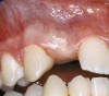 Figure 27   VIRTUAL PLANNING AND SURGERY Before implant surgery, the orthodontic brackets were removed, revealing the position of the centrals, and the anatomical variations of the crestal tissue and lack of interdental papilla.