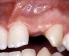 Figure 28   VIRTUAL PLANNING AND SURGERY Before implant surgery, the orthodontic brackets were removed, revealing the position of the centrals, and the anatomical variations of the crestal tissue and lack of interdental papilla.