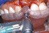 Figure 32  VIRTUAL PLANNING AND SURGERY A surgical template was derived from the final treatment plan created in the software, which facilitated the drilling sequence and precise location of placement.