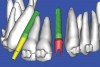 Figure 39  IMPLANT PLACEMENT A patient-specific abutment was designed in the software directly from the CT data.