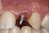 Figure 42  IMPLANT PLACEMENT The patient-specific, computer-milled abutments were placed.