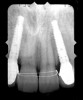 Figure 43  FINAL RESULTS The final radiograph confirmed the fit of the abutment-implant-crown interfaces.
