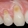 Figure 1  Case One Pretreatment clinical view, Case 1, maxillary right.