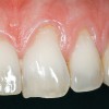 Figure 2  Case One Pretreatment clinical view, Case 1, maxillary anterior.