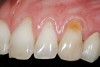 Figure 3  Case One Pretreatment clinical view, Case 1, maxillary left.