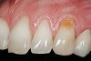 Figure 3  Case One Pretreatment clinical view, Case 1, maxillary left.