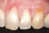 Figure 5  Case One Root preparation of teeth Nos. 9 through 11.