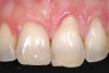 Figure 6  Case One Root preparation of teeth Nos. 9 and 10.