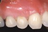 Figure 11  Case One The 2.5-week postoperative view, maxillary right.