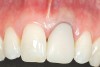 Figure 16  Case Two Preoperative clinical view, maxillary left central incisor.