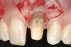 Figure 17  Case Two Initial incision, prepared root surface, and margin alteration.