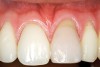 Figure 21  Case Three Pretreatment view, Case Three, left central incisor.