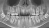 Figure 22  Case Three Preoperative panoramic view.