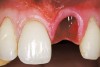 Figure 23  Case Three Atraumatic extraction, left central incisor.