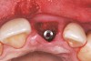 Figure 24  Case Three Minimally invasive bone grafting, occlusal view.