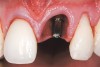 Figure 25  Case Three Titanium abutment seated