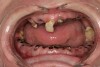 Figure 1  DEVASTATING EFFECTS When smoked, methamphetamine produces highly toxic and corrosive fumes of lithium, muriatic, and sulfuric acids that can destroy enamel rapidly. With continued use, methamphetamine can produce severe, rampant caries. When someone presents with rampant anterior lesions it should be a red flag for methamphetamine use.