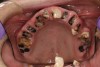 Figure 2  DEVASTATING EFFECTS When smoked, methamphetamine produces highly toxic and corrosive fumes of lithium, muriatic, and sulfuric acids that can destroy enamel rapidly. With continued use, methamphetamine can produce severe, rampant caries. When someone presents with rampant anterior lesions it should be a red flag for methamphetamine use.