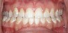 Figure 1  CLINICAL EXAMPLE Poor oral hygiene during orthodontic treatment can result in decalcified and carious enamel at the end of treatment. (Photograph courtesy of Dr. Andrew Kious.)