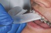 Figure 3  BLEACHING PROCEDURE  The path of insertion of the tray should be from the facial. Try in the tray with the patient before heating to ensure a proper path of insertion and full patient understanding of relaxing their lip