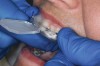 Figure 4  BLEACHING PROCEDURE After the softened tray is seated correctly, quickly apply finger pressure on the facial and lingual of the tray to adapt to the gingival areas, starting from the midline and proceeding distally.