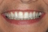 Figure 12  CLINICAL RESULTS fter removal of the brackets, there are no yellow spots or unbleached areas on the teeth, and no white spots from demineralization of the enamel.