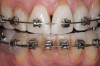 Figure 13  CLINICAL RESULTS Any yellow or discolored areas on the teeth will generally be attributed to the composite bonding material, which penetrates 25 ¬µm into the enamel, and must be removed by abrasion.