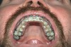 Figure 14  CLINICAL RESULTS Because the thermoplastic trays only come in one size, the most posterior teeth are often not included in the tray. However, the increase in pH in the mouth may still protect them from caries.