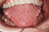 Figure 4  SYMPTOMS OF THE TRIAD Indentations on tongue caused by forceful pressing of tongue on lingual surfaces. By pushing the tongue anteriorly, the airway is opened.