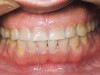 Figure 8  RESULTS OF THE TRIAD Young adult with signs and symptoms of the bruxism triad: Lateral tooth wear, erosive and abrasive damage to the teeth, and a history of moderate apnea.