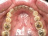 Figure 9  RESULTS OF THE TRIAD Extensive erosive wear. Airway improvement can reduce GERD and GERD resolution can reduce sleep bruxism.