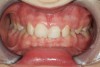 Figure 12  Recognizing Triad Patients, Childhood presentation of the bruxism triad. Patient had erosive and attritional wear on deciduous teeth, constricted dental arches, and deep class II bite. Physician examination revealed significant GERD paired with enlarged adenoids and tonsils.