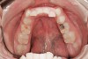 Figure 15  Early Signs and Treatment, Patient demonstrates wear on deciduous molars increasing the risk of bruxing as an adult. Another explanation may be the triad. Constricted dental arch, crowded lower anteriors, and a deep bite with a lifetime of airway-related issues. GERD history coupled with erosive wear on teeth.